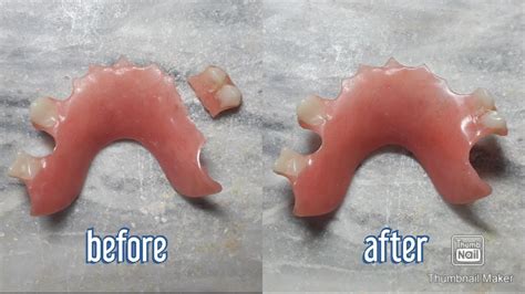 Repair Broken Partial Denture Ada Code