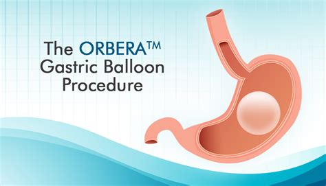 7 Things to Know About the ORBERA Gastric Balloon Procedure : ObesityHelp