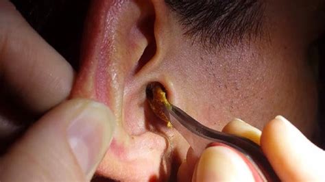 Top Remedies To Get Rid Of Clogged Ear Easily. - YouTube