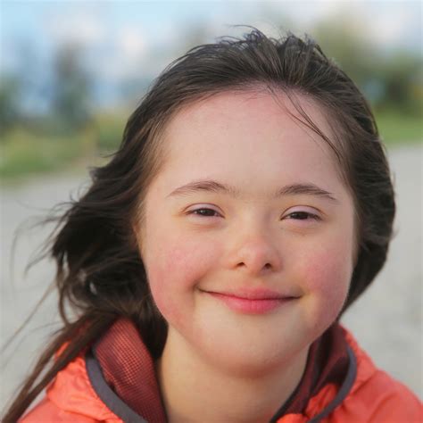 Down Syndrome Physical Features and Facial Characteristics