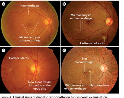 Diabetic retinopathy | Semantic Scholar