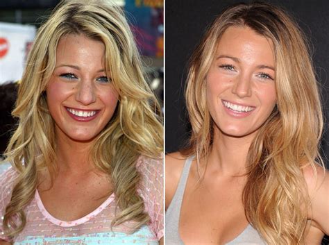 Blake Lively, Before and After | Celebrity beauty secrets, Celebrity ...