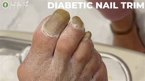 Diabetic Nail Trim - YouTube