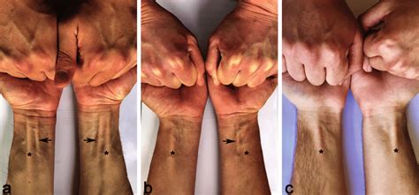 Thompson's test for visualization of the tendon of the palmaris longus ...