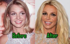 Britney Spears Plastic Surgery – CelebritySurgeryIcon