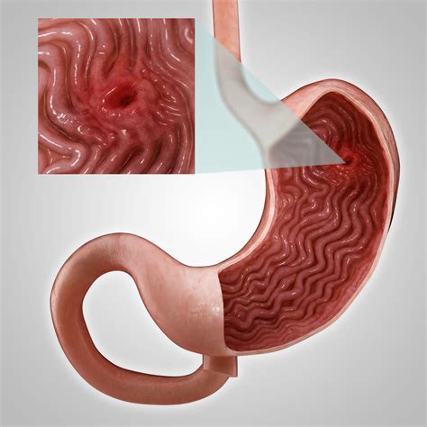 Peptic Ulcer Stomach Disease Infographic Poster Cause - vrogue.co