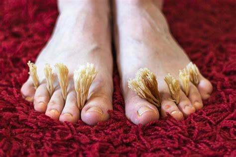 Coral Fungus Between The Toes Of Female Feet Fungal Skin Diseases Concept Stock Photo - Download ...