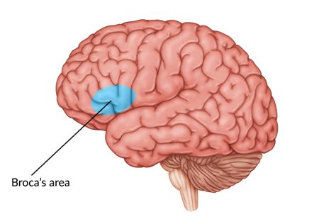 Damage to Broca's Area: Speech Impairment After Brain Injury