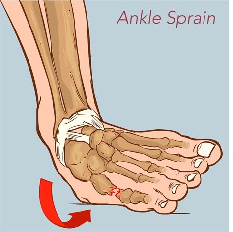 Rolled Ankle Symptoms