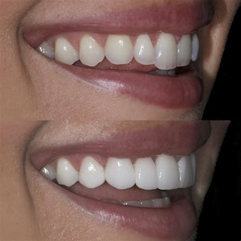 Diy Veneer Teeth / perfect smile veneers Upper Veneer Dental Artificial perfect smile teeth ...