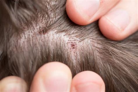 Scalp Scabs Causes Symptoms And How To Heal Scalp Acn - vrogue.co