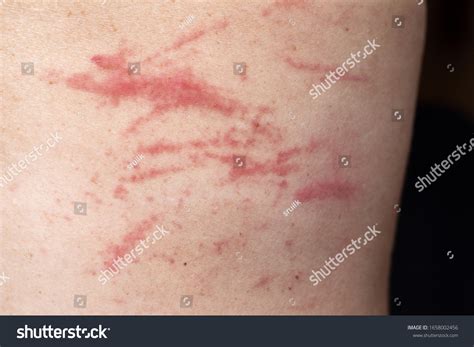 258 Skin Excoriation Images, Stock Photos, 3D objects, & Vectors ...