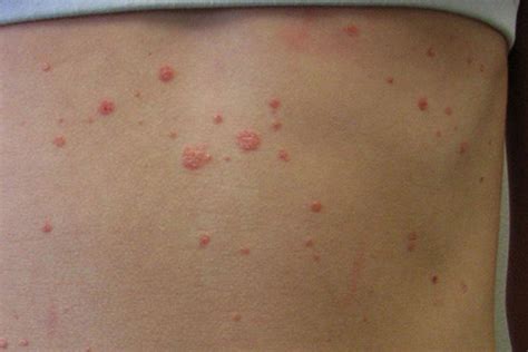 Psoriasis In Children: Symptoms, Types How To Deal With It, 50% OFF