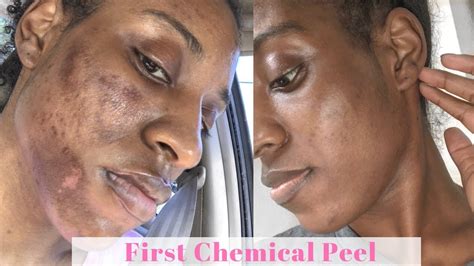 Before and After Chemical Peel Black Skin: See the WOW Results!