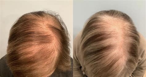 Hair Restoration Before & After Photos Patient 49 | Washington, DC | MI Skin Dermatology Center ...