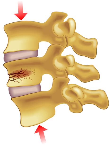 Vertebral Compression Fracture Treatment in NJ and NYC | Premier Brain ...