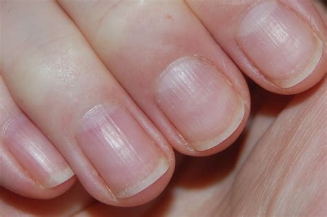 Causes Of Brittle Nails With Ridges at Sarah Gibson blog