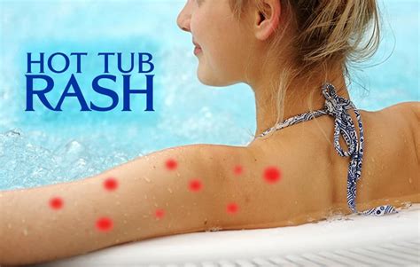 The Truth About Hot Tub Rash – and How to Prevent It | Hot tub, Tub, Itching skin