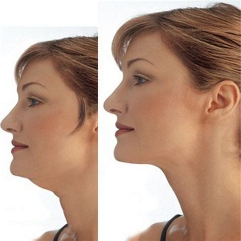 Get Rid Of Loose Neck Skin & Neck Skin Exercises | Chin exercises ...