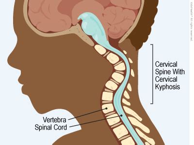 Cervical Kyphosis (for Parents) - Rady Children's Hospital (XML)