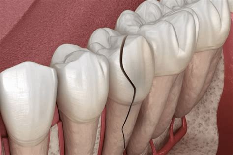 Crack Tooth Syndrome | Atlas Dental, Toronto Dentist