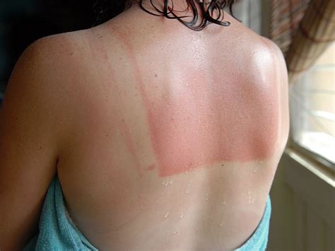 Does a Sunburn Turn into a Tan? What to Expect