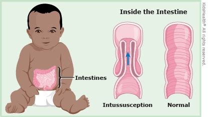 Intussusception (for Parents) | Nemours KidsHealth