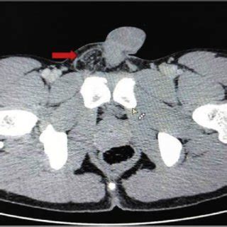 e Contrast enhanced computerized tomography (CECT) abdomen showing... | Download Scientific Diagram