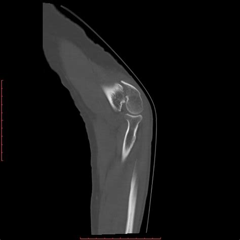 Distal humerus fracture - wikidoc