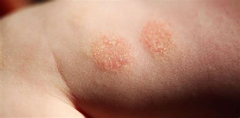 Nummular Dermatitis Causes Clear Skin Clinic