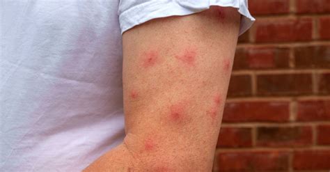 Why Mosquitoes Bite Some People More Than Others | Passport Health
