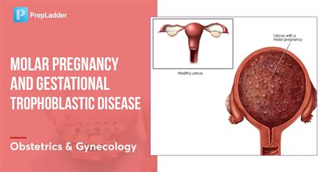 Molar Pregnancy and Gestational Trophoblastic Disease - NEET PG OBGYN