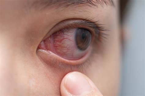 Herpes Eye Infections: Prevention And Treatment | Atlantic Eye Institute