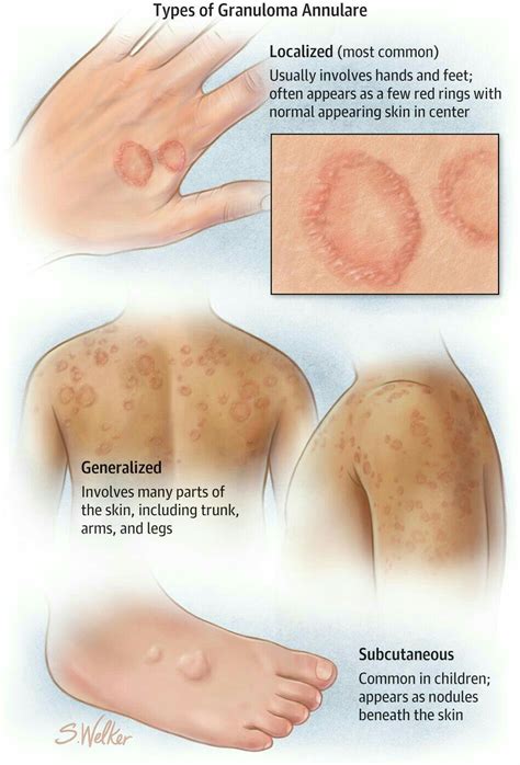 Granuloma Annulare | Dermatology nurse, Granuloma annulare, Dermatology