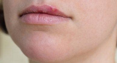 Red Bumps On Lips Treatment