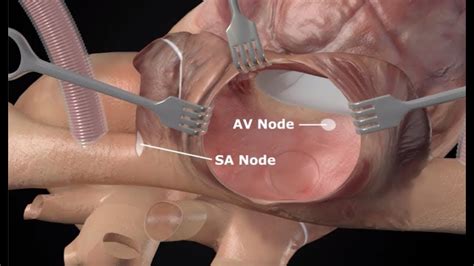 Cox-Maze IV Procedure Animation for Surgical Ablation - YouTube