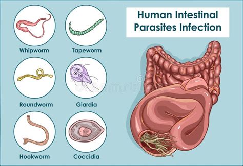 Vektor-Illustration Von Menschliche Intestinale Parasiten Vektor ...