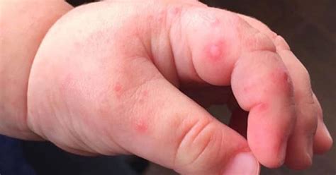 Mom Finds Blisters On Baby’s Hand. She’s Now Warning All Parents About The HFMD Virus.