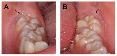 Children | Free Full-Text | A Case of X-Linked Hypophosphatemic Rickets with Dentin Dysplasia in ...