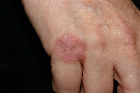 Granuloma Annulare - Causes, Rash, Treatment