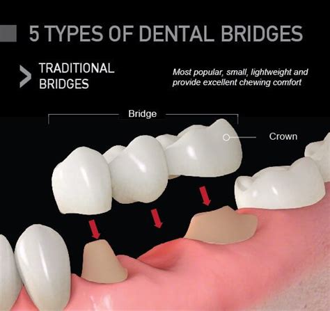 Types of Dental Bridges: What Type is Best for Me? | Dental bridge, Dental bridge cost, Dental