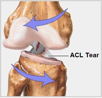 ACL Knee Injury: Causes, Symptoms & Treatment - Knee Pain Explained