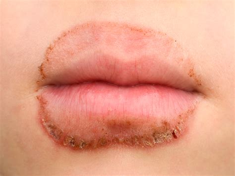 Droge lippen en lip-licking dermatitis (patientenfolder)