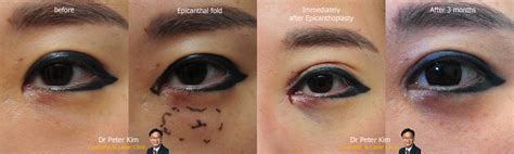 Mongolian Fold Surgery (Epicanthoplasty) - Dr Peter Kim Cosmetic & Laser Clinic