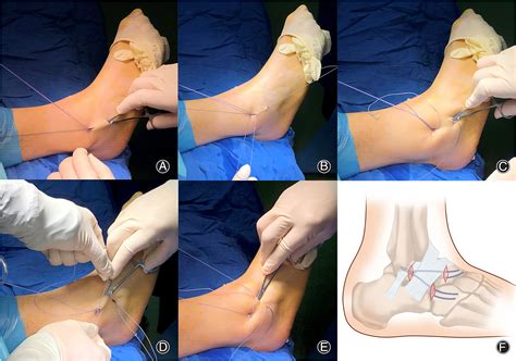 Inferior Extensor Retinaculum Of Foot Clearance Shops | www.pinnaxis.com