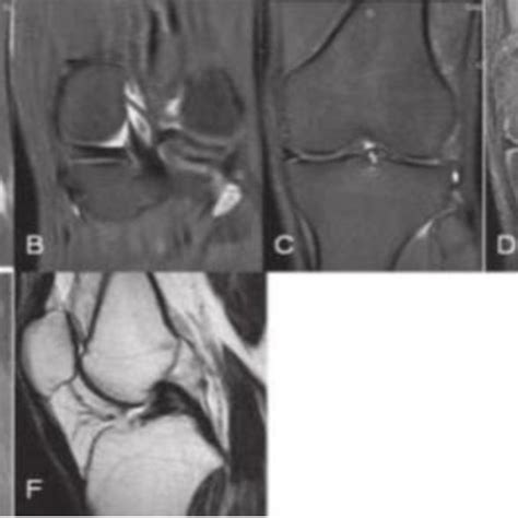 (PDF) Bucket Handle Tear of Lateral Meniscus on MRI - A Case Report