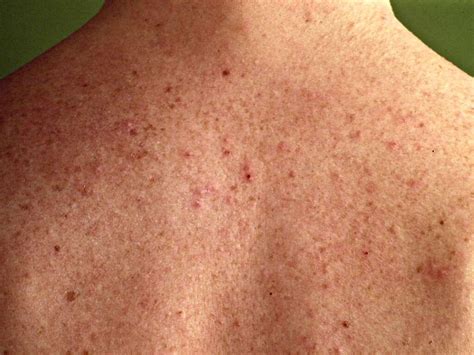 Folliculitis Images