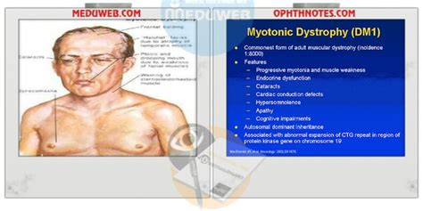 Myotonic dystrophy capsule - Meduweb