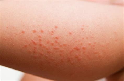 Allergic Reaction Rash - Pictures, Causes, Treatment, Symptoms