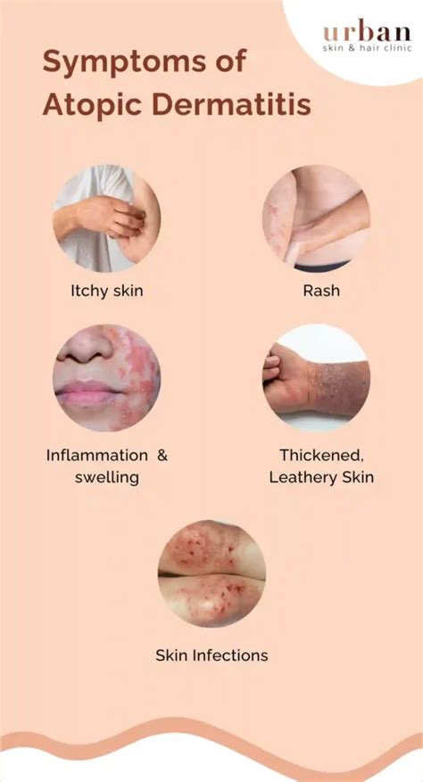 Atopic Dermatitis Types, Causes & Symptoms | USHC
